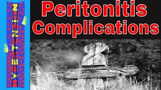 Diverticulitis to Peritonitis  Peritonitis and Sepsis Complications [upl. by Kylah256]