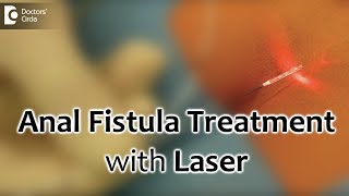 Anal Fistula Treatment with Laser Painless and best recovery for fistula  Dr Rajasekhar M R [upl. by Meredeth611]