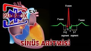 EKG  SİNÜS RİTMLERİ  Sinüs Aritmisi [upl. by Hamachi]