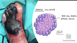 Necrosis and its types coagulative liquefactive caseous fat fibrinoid necrosis fmge neetpg [upl. by Akinwahs]