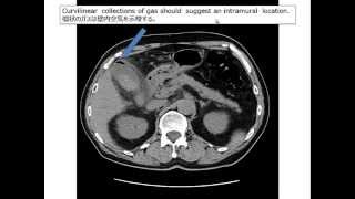 Emphysematouc cholecystitis answer 20140820WMV [upl. by Itirahc]