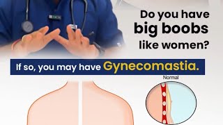 KNOW ABOUT GYNECOMASTIA [upl. by Leahciam509]