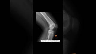 OsgoodSchlatter disease [upl. by Gascony]