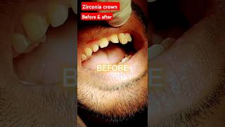 Zirconia crown  before and after  shorts veneers viralshorts [upl. by Keffer]