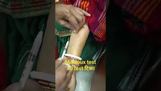 Mantoux test TB ka test skin test shorts short video [upl. by Annodal774]