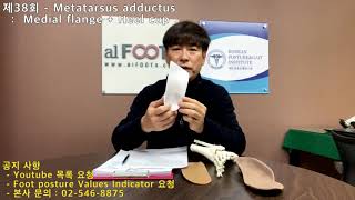 제38회  Metatarsus adductus  Medial flangeHeel cup [upl. by Aneerol]