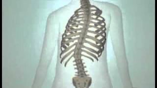 Teen Scoliosis Causes and Treatment Options DePuy Videos [upl. by Anaic]