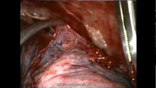 Thoracoscopy VATS Decortication in stage 2 empyema Delhi Noida India [upl. by Nasar587]