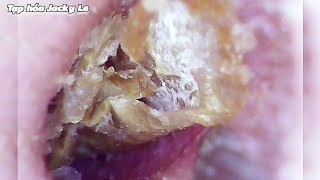 Ear Wax Removal 111 The Earwax Was So Big That He Couldnt Sleep  Ear Cleaning ASMR [upl. by Nosinned]