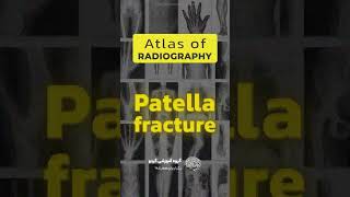 Patella fracture in a 34 yo man 🦵🦵 anatomy fracture medicalshorts [upl. by Tillfourd]