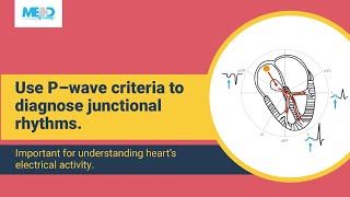 How to diagnose junctional rhythms [upl. by Fridlund207]