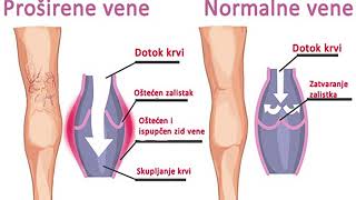 ODABERI ZDRAVLJE  PROBLEMI S VENAMA [upl. by Ambrogio]