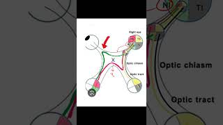 Junctional Scotoma insightophthalmology visual field ophthalmology [upl. by Chanda]