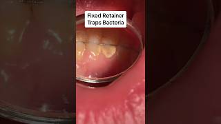 Retainers keep teeth together Removable retainers vs fixed retainer cosmeticdentistry retainers [upl. by Enar65]