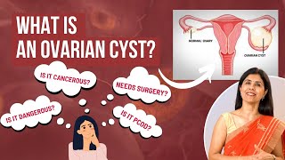 What is an Ovarian Cyst  Dr Anjali Kumar  Maitri [upl. by Nosraep]