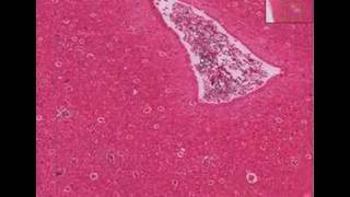 Histopathology BrainParesis syphilis [upl. by Malik]