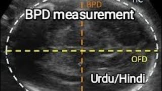 Biparietal Diameter measurement on ultrasound BPD measure krna Ka Tariqa [upl. by Skipper]