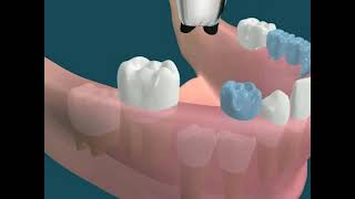 Dental Video for Space Maintainer  The Tooth [upl. by Rotsen925]