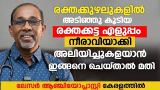 രക്തക്കുഴലുകളിൽ അടിഞ്ഞു കൂടിയ രക്തക്കട്ട എളുപ്പം നീരാവിയാക്കി അലിയിച്ചുകളയാൻ  Laser Angioplasty [upl. by Nassir]