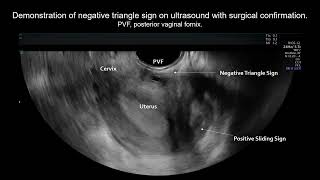 ‘Triangle sign’ used to enhance assessment of culdesac obliteration in cases of retroverted uterus [upl. by Nailluj397]