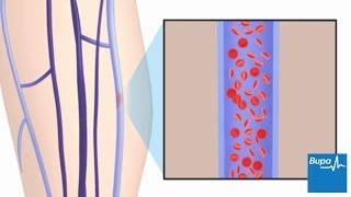 How superficial thrombophlebitis develops [upl. by Alasteir795]