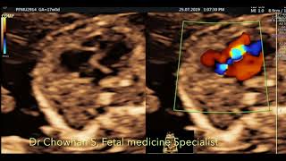 Ebsteins anomaly by Dr Chowhan S Fetal Medicine Specialist [upl. by Smoot]