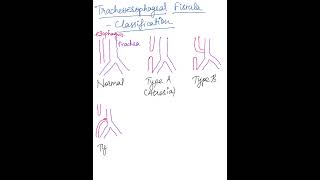 Trachoesophageal Fistula  Types surgeryeducationmbbsneetpg usmleplabfmge pediatricsinicet [upl. by Garvy]