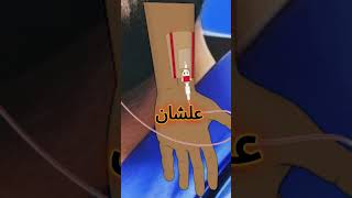 ليه بنركب الكانيولا الشريانية للمريض ؟  arterial cannula  arterial line [upl. by Enaols]