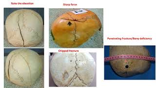 Head Injuries and medicolegal aspects  Part 1 Scalp fractures and intracranial haemorrhages [upl. by Raddie]