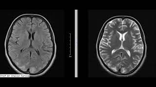 Posterior reversible encephalopathy PRES syndrome [upl. by Flosi]