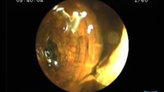 Direct Cholangioscopy with Standard Ultraslim Endoscopes [upl. by Arikal735]