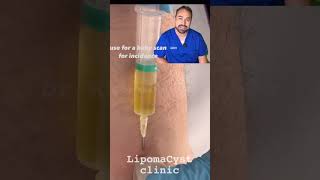 Bakers cyst treatment skincare dr Khaled Sadek explains [upl. by Lovato727]