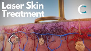 Next Generation Laser Treatment of Skin Lesions and Pigmentation by Candela 3D medical animation [upl. by Sacram]