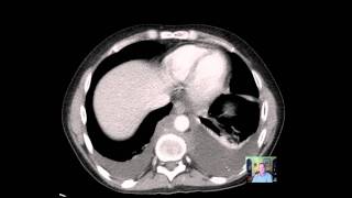 CT Chest ADENOPATHY Discussion [upl. by Iris433]