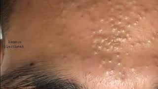 Forehead Acne amp Blackhead Treatment  Blackhead Removal on forehead removeblackhead [upl. by Uno]