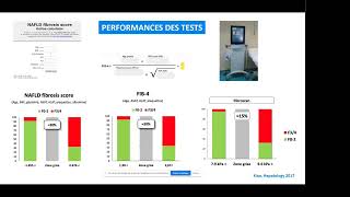 Stéatose Hépatique Non Alcoolique  NASH  NAFLD [upl. by Boucher]