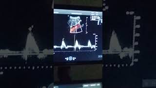 PRACTICA DE ECO DOPPLER AORTA [upl. by Helve]