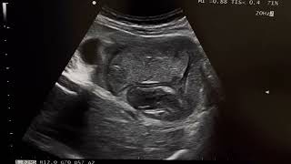 Hepatic Hydatid Cyst Ultrasound radiology ardms sonography sonographer [upl. by Eat463]