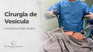 Cirurgia Real de Vesícula por Vídeo [upl. by Sheaff]