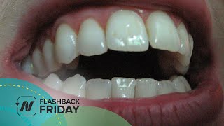 Flashback Friday Oil Pulling Benefits for Plaque Gingivitis Teeth Whitening and Bad Breath Tested [upl. by Imoyn515]