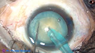 Management of an intumescent cataract under Topical  An unedited recording [upl. by Kurland]