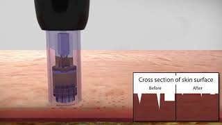 Tratamiento con Dermapen para difuminar Cicatrices y Manchas [upl. by Dixon]