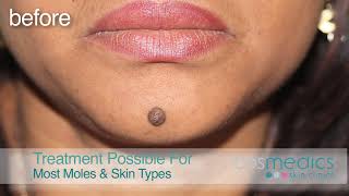 Mole Removal Surgery for Best Results at London amp Bristol Clinics [upl. by Mihe]