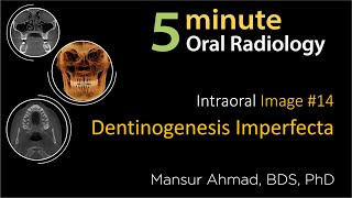 Dentinogenesis Imperfecta Intraoral Radiographic Interpretation [upl. by Trevar]