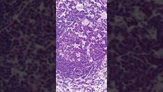 Toxoplasma Lymphadenitis Histology [upl. by Tram611]