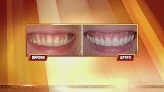 Get Rid Of Receding Gums 6115 [upl. by Amlez]