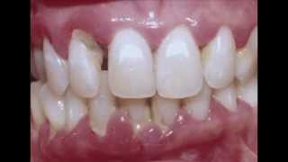 Periodontitis  Cure your Gum with Dr Mark Bonner [upl. by Wadsworth]