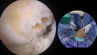 Anatomic Double Bundle Transtibial Anterior Cruciate Ligament Reconstruction With Ligament Advanced [upl. by Aicital]