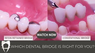 Resin Bonded Bridges vs Conventional Bridges  Missing Tooth [upl. by Attwood99]