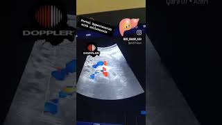 A case of portal hypertension with collaterals channel formationdoppler day 24 [upl. by Rosalind]